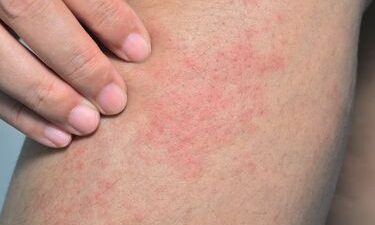 6 Cara Mengatasi Biang Keringat secara Alami dan Pakai Obat