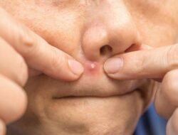 Jangan Pencet Jerawat di Hidung-Mulut, Picu Infeksi hingga Kematian