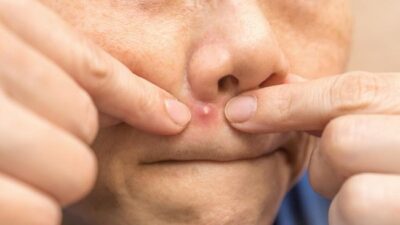 Jangan Pencet Jerawat di Hidung-Mulut, Picu Infeksi hingga Kematian