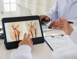 6 Penyebab Stroke Penyumbatan Otak, Waspadai Gaya Hidup Tak Sehat