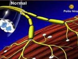 RI Tetapkan Kejadian Luar Biasa Usai Temukan Lagi Kasus Polio!
