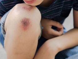 7 Cara Menghilangkan Bekas Luka yang Menghitam secara Alami 