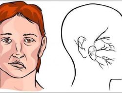 Penyebab Stroke di Usia Muda yang Perlu Diwaspadai