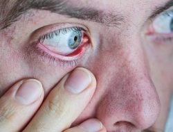 Gejala Stroke Mata yang Perlu Anda Ketahui