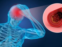 4 Gejala Awal Pecah Pembuluh Darah di Otak, Awas Sering Disepelekan