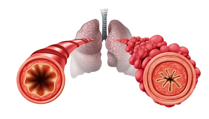 Paru-paru Popcorn, Penyakit Langka yang Dipicu Paparan Vape