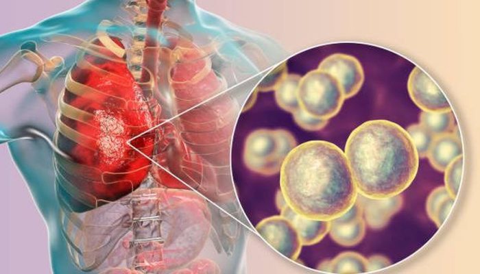 Cegah Pneumonia Misterius dari China, Ini Peringatan Waspada Kemenkes
