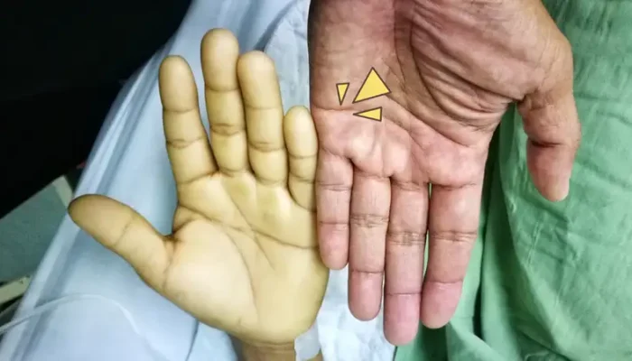 Viral Efek Samping Obat Sakit Kepala Picu Anemia Aplastik, Profesor Farmasi Buka Suara