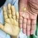 anemia aplastik