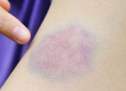 Kenali Leukemia yang Menyerang Sel Darah dalam Tubuh