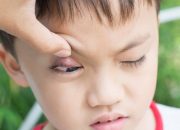 Tips Atasi Bintitan pada Anak dengan Cara Rumahan
