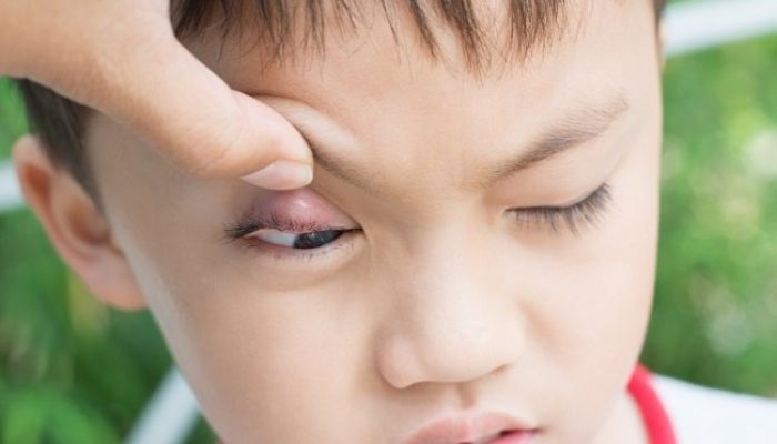 Tips Atasi Bintitan pada Anak dengan Cara Rumahan
