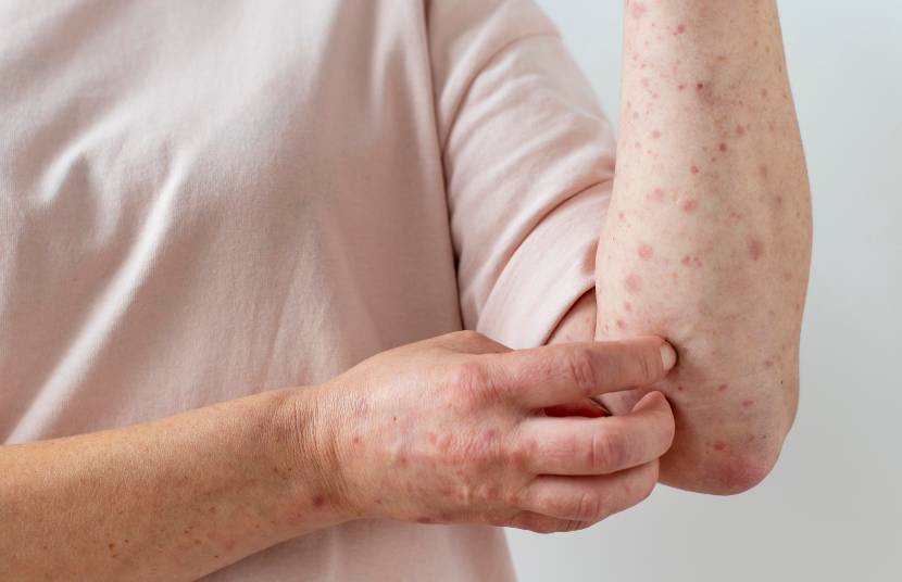 Virus Mpox atau Cacar Monyet