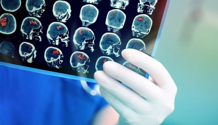 Hati-hati, Kedutan Ternyata Bisa Jadi Gejala Kanker dan Tumor Otak