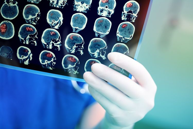Gejala Kanker dan Tumor Otak