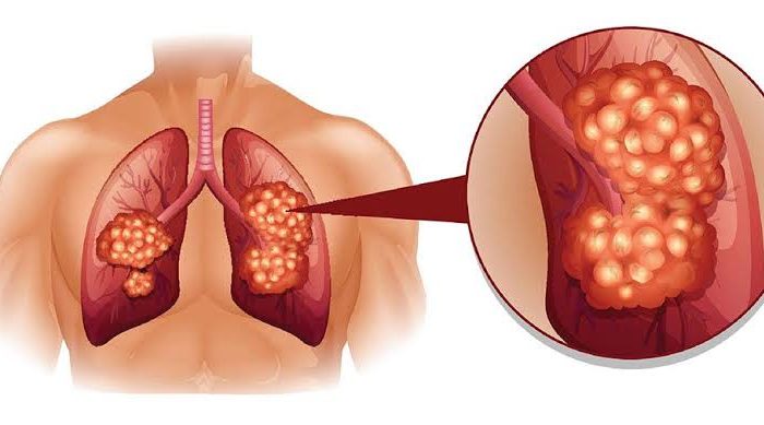 Jangan Disepelekan, Batuk Seperti Ini Bisa Jadi Gejala Kanker Paru-paru