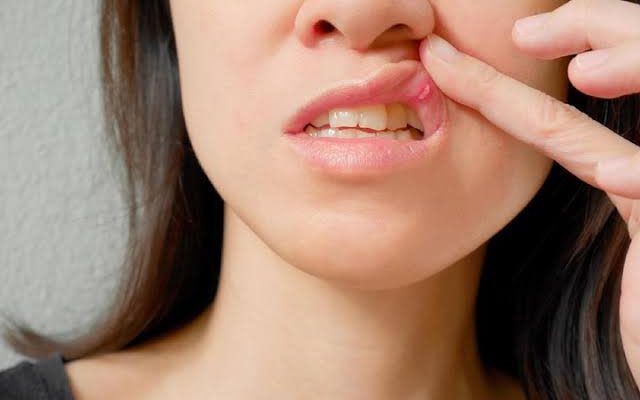 Gejala Kanker Mulut yang Kerap Tak Disadari, Termasuk Sariawan
