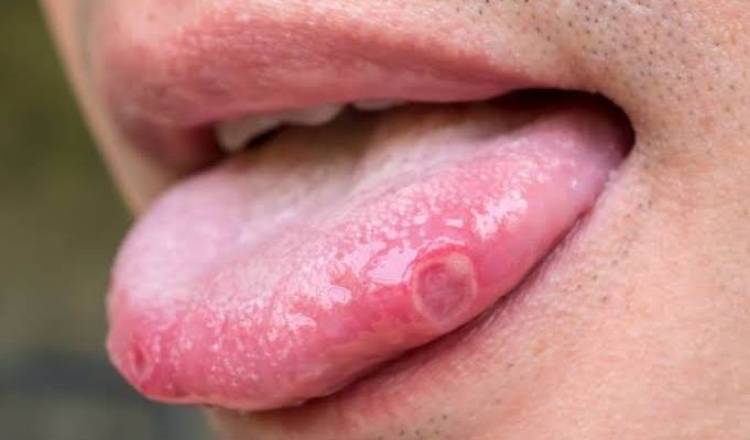Dokter Ungkap Ciri-ciri Sariawan Tanda Kanker Lidah, Waspadai Jika Tak Kunjung Sembuh