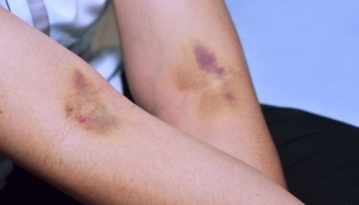7 Penyakit Akibat Pembuluh Darah Pecah dan Penyebabnya