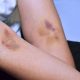 Penyakit Akibat Pembuluh Darah Pecah