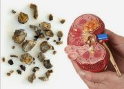 6 Minuman yang Bisa Bantu Keluarkan Batu Ginjal