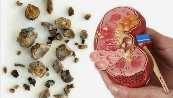6 Minuman yang Bisa Bantu Keluarkan Batu Ginjal