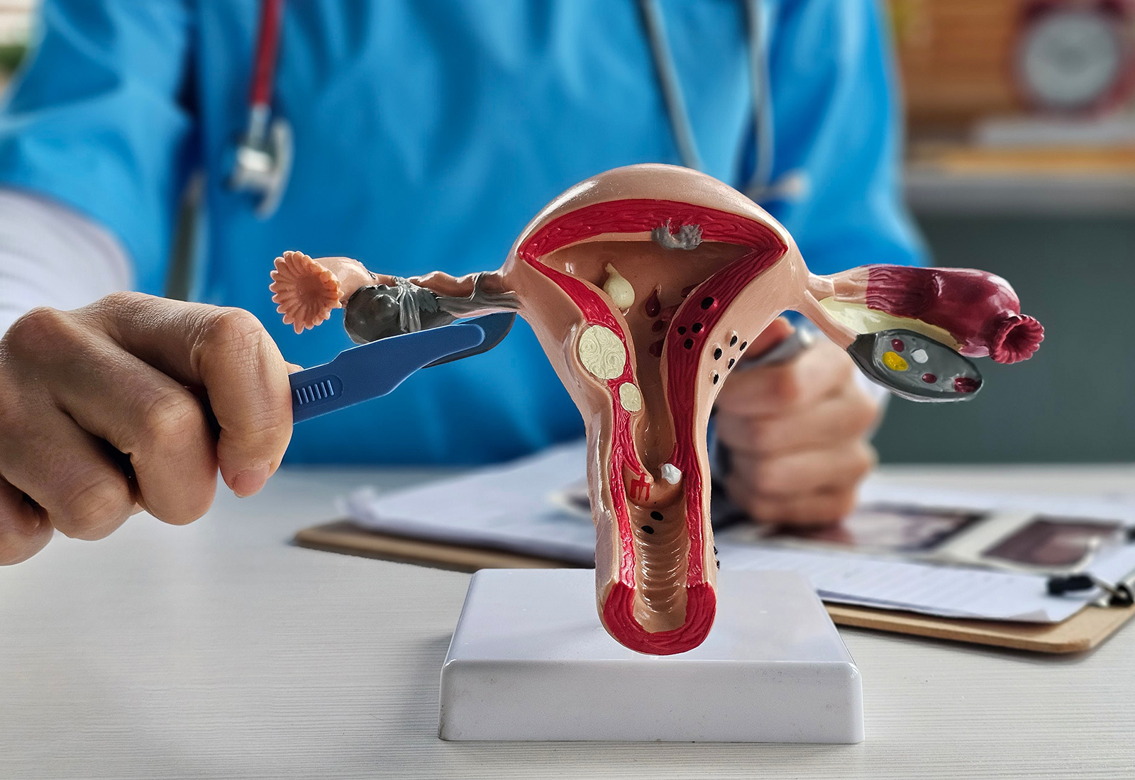 Cewek Cewek Perlu Tahu, Ini Masalah 'Tersembunyi' di Rahim yang Bisa Ganggu Kesuburan