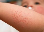 Iritasi Kulit Bayi saat Cuaca Tak Menentu, Ini Saran Dokter