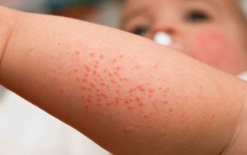 Iritasi Kulit Bayi saat Cuaca Tak Menentu, Ini Saran Dokter