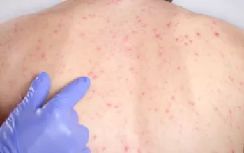 Dokter Ungkap Pemicu Orang Dewasa Rentan Kena Campak Gejala Berat